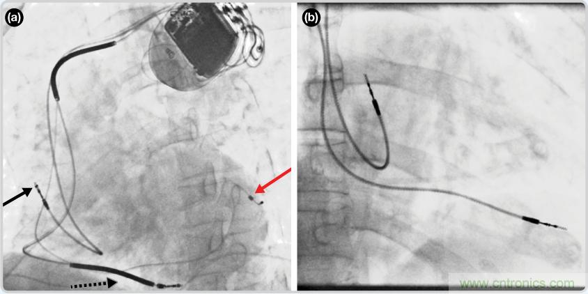 檢測并區分心臟起搏偽像